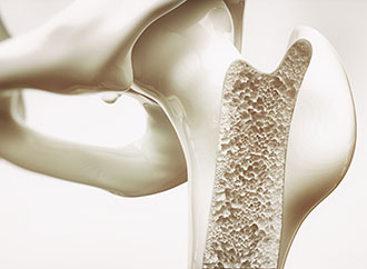 Osteoporosis