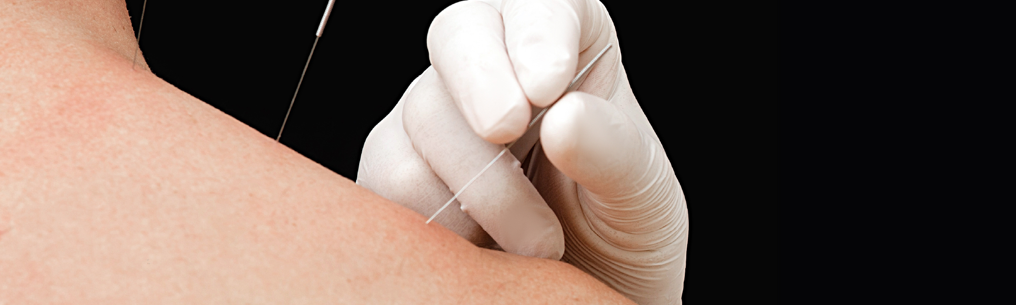 acupuncture needle being inserted