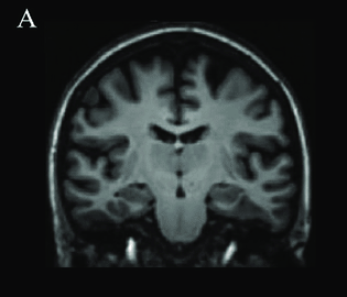 Structural MRI brain