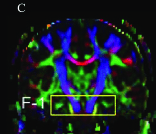 Diffusion MRI brain