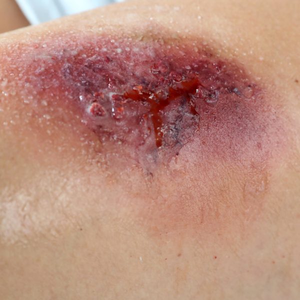 22.08.18 mh TDS Wounds Cardiff UNIV 34